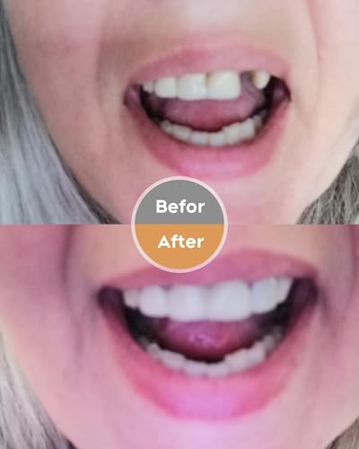 Denture Kit, Functional Homemade Denture Combo, Full Set of Top and Bottom Fake Teeth, Improve Smile, Eat & Drink, Long or Short-term denture solution-AE-0-01