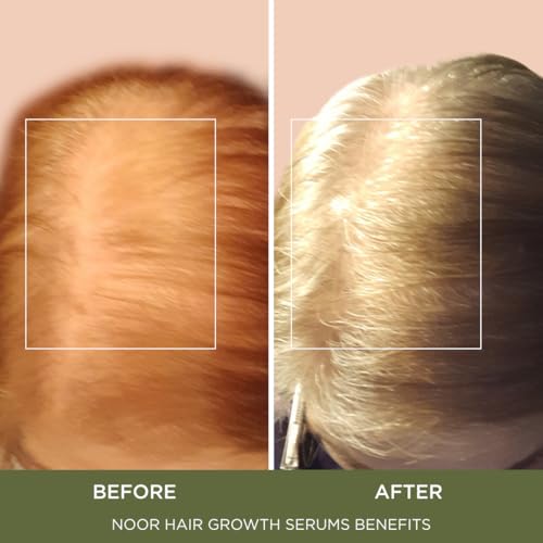 Wonder Growth Spray for Women, 9-in-1 SuperBoost, Natural Hair Loss Treatment with Coffee Bean Extract & Cynatine Keratin for Thicker, Healthier Hair Promotes Significantly Fuller Hair in 8-12 Weeks