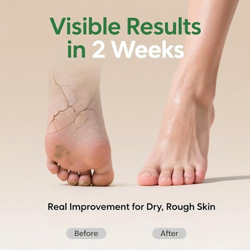 60% Urea Cream with 2% Salicylic Acid, Urea Cream 60 Percent for Feet & Hands, Maximum Strength Moisturizer Foot Lotion for Dry Cracked Heels Feet Knees Elbows Hands, Callus Remover, 10.1 fl oz