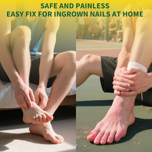Titanium Alloy Ingrown Toenail Treatment & Removal Kit for Quick Relief, Ingrown Toenail Removal Kit， Professional Ingrown Toenail Corrector, Ingrown Toenail Tools for Quick Relief, 10 Pcs