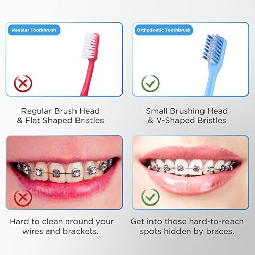 V-Shaped Orthodontic Toothbrush for Braces, Soft Bristles, 6 Count, with Interdental Brushes