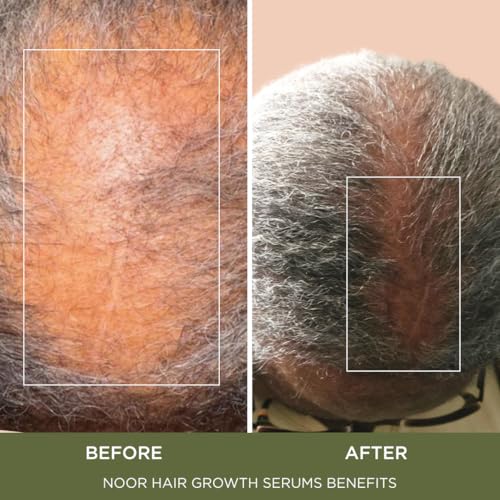 Wonder Growth Spray for Women, 9-in-1 SuperBoost, Natural Hair Loss Treatment with Coffee Bean Extract & Cynatine Keratin for Thicker, Healthier Hair Promotes Significantly Fuller Hair in 8-12 Weeks