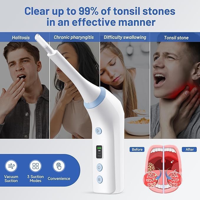 Electronic Tonsil Stone Remover, Vacuum Tonsil Stone Removal Kit with LED Light, 3 Suction Modes, Tonsil Stone Cleaner Tool,Oral Care for Mouth Health, Fight Bad Breath Instant Suction Irrigator