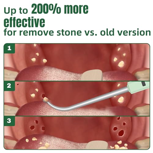 2025 Best Tonsil Stone Remover 6pcs Extended LED Light Guiding Scoop Curved Tonsil Stone Removal Kit Remove Tonsil Stone Water Flosser Oral Irrigator Tool Rinse Syringe Cleaner Fresh Breath Soft