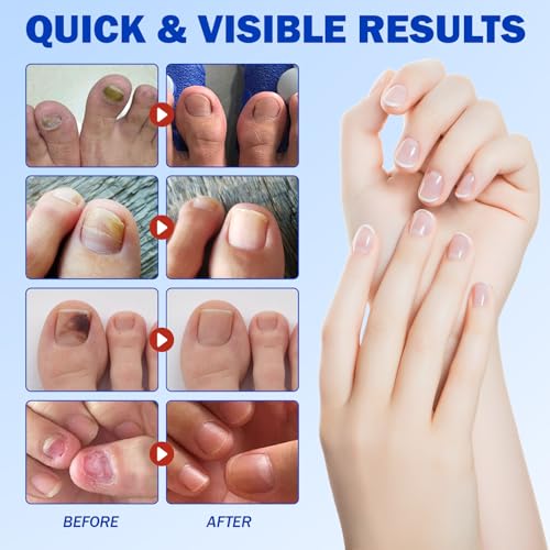 Nail Patches 42 PCS Toenail Treatment Extra Strength 8-Hour Overnight Nail Fast Acting Repair Effortless Hydrogel Nail Care and Repair for Damaged Nails Overnight Renewal for Men and Women
