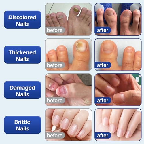 Multi-Purpose Nail Repair, Nail Solution with Tea Tree Oil for Discolored and Damaged Nails，Plant Drops for Nails Care，Discolored and Damaged Nails (1PC) ﻿